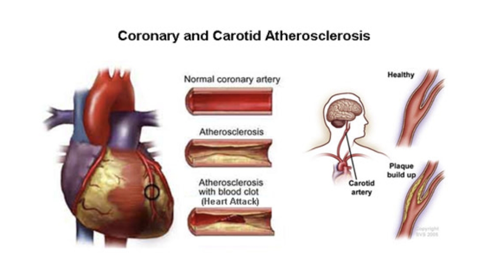 Atherosclerosis develop plaque to block the blood supply to brain and heart and cause heart attack and stroke.